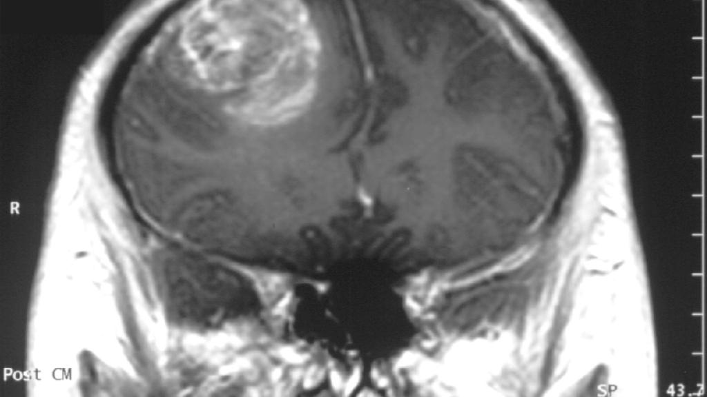 Glioblastoma_-_MR_coronal_with_contrast