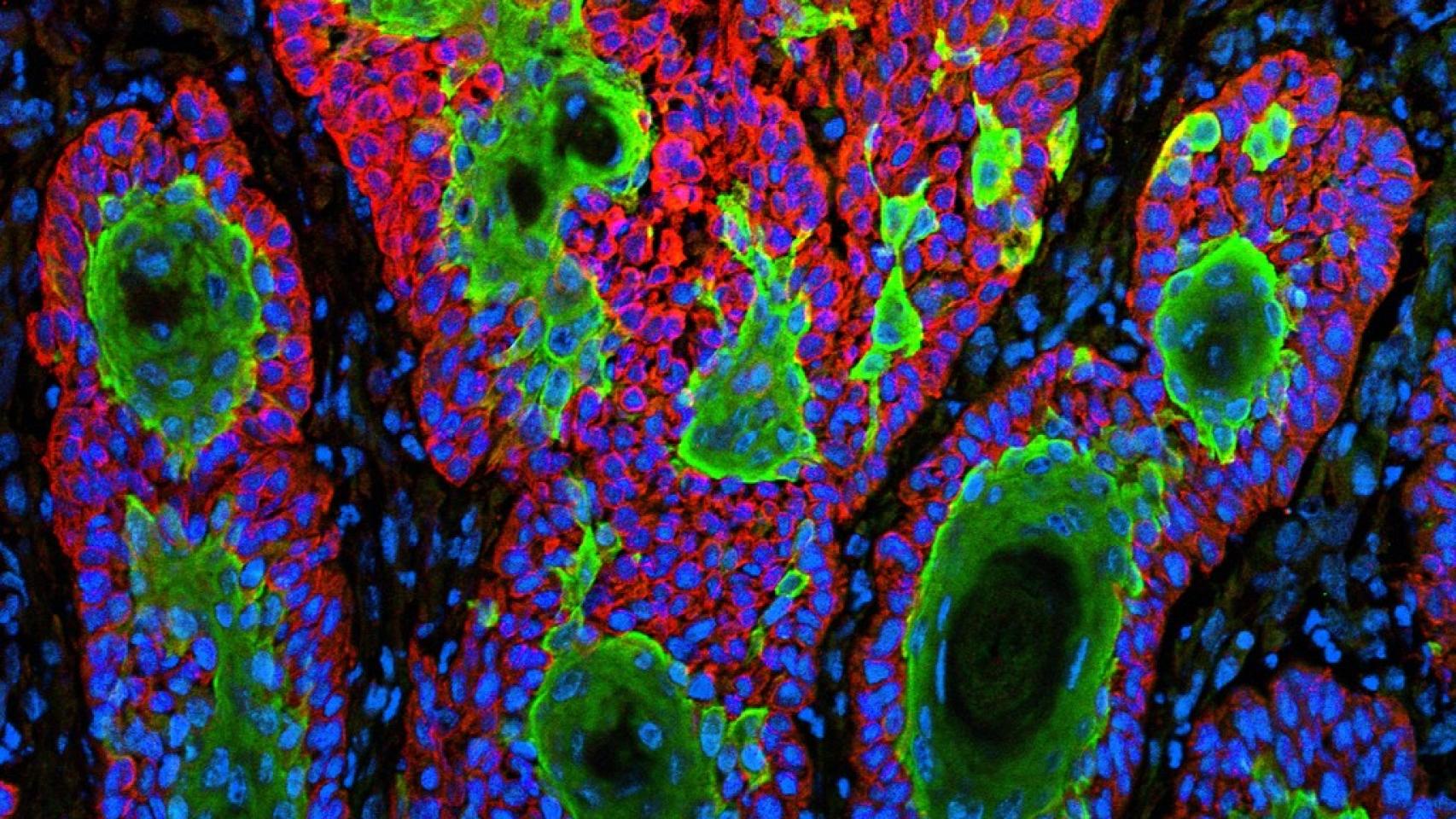 Una muestra de cáncer de piel.