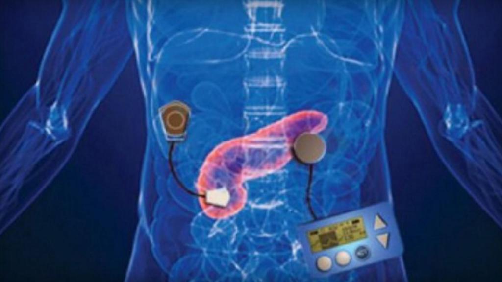 pancreasbionico1