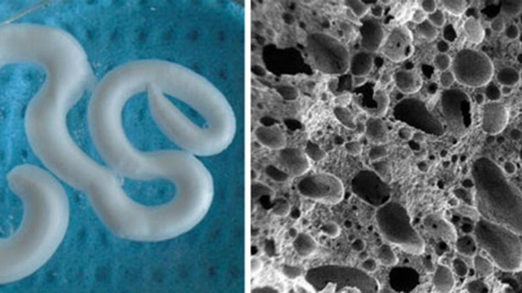 osteoporosisespumainyectable1