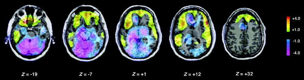 mecanismocerebraldelsueño2