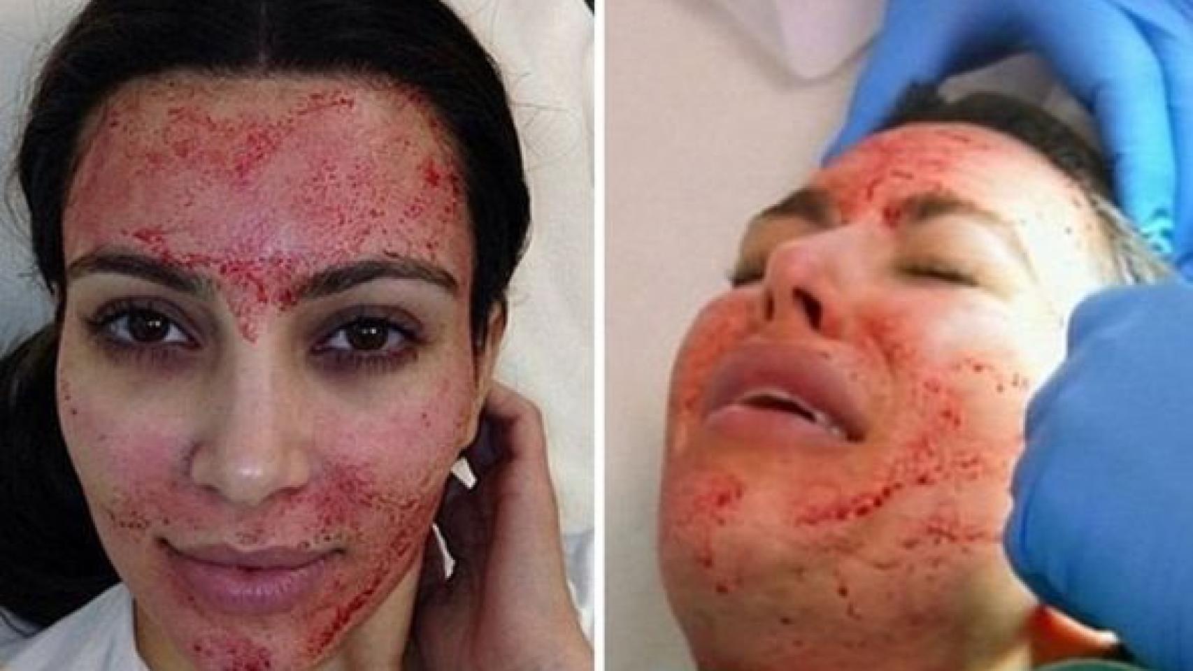 Kim Kardashian mientras es sometida al tratamiento Vampire Breast Lift