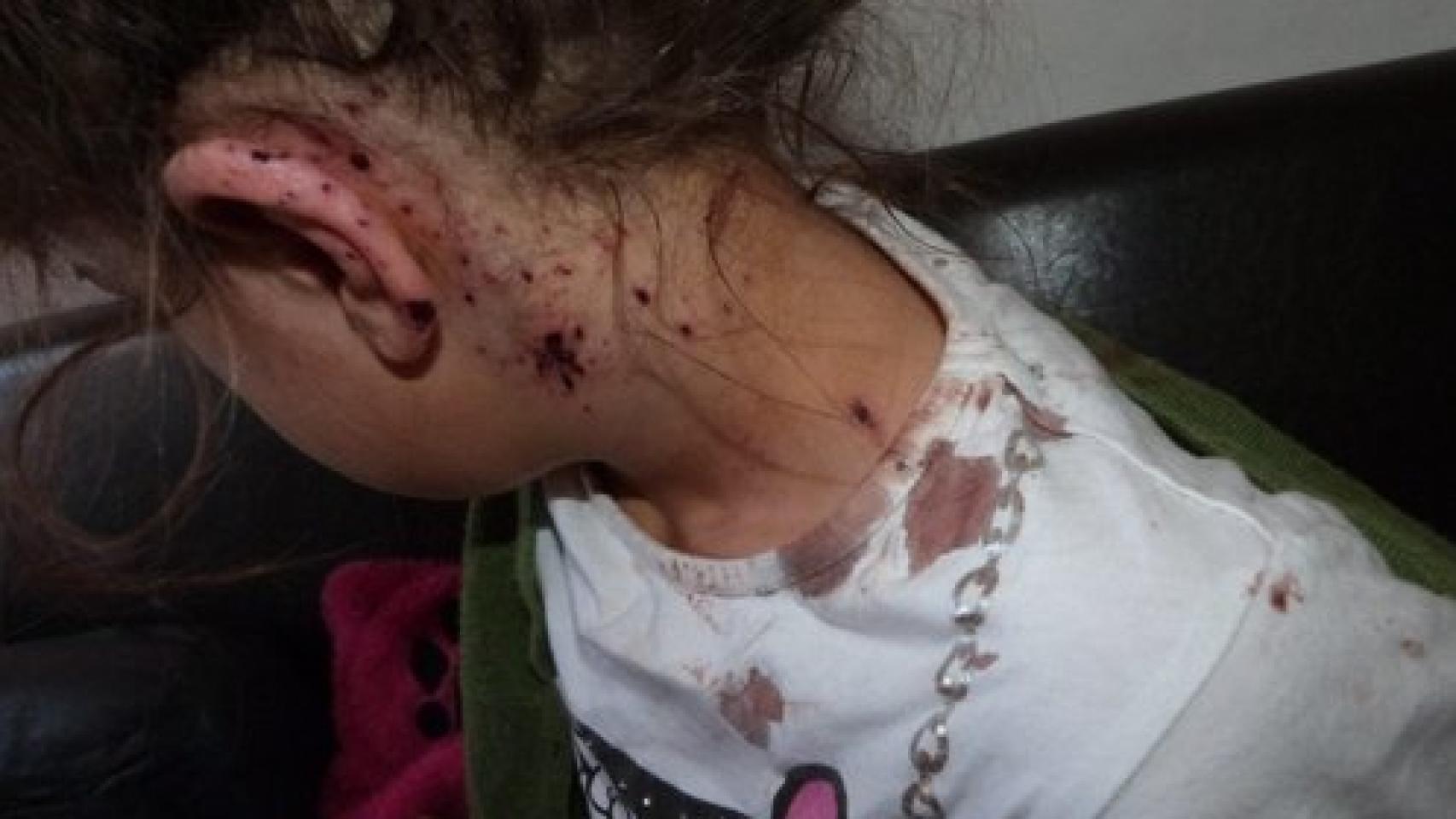 Pequeña herida supuestamente durante una redada en Niza