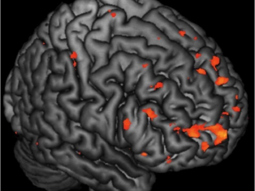 Anomalías en el cerebro de familias de esquizofrenicos.