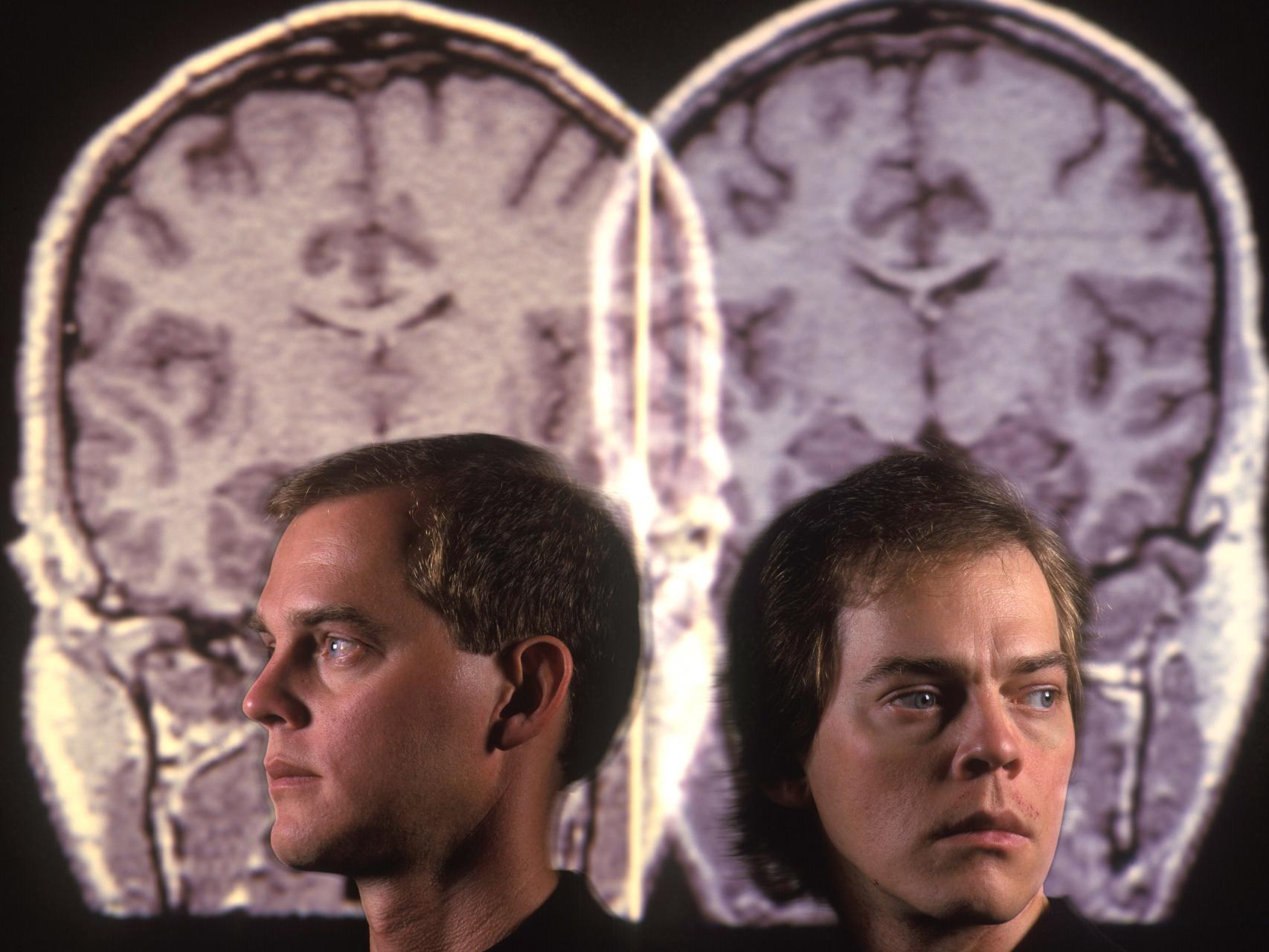 Un hermano esquizofrénico y su hermano sano.