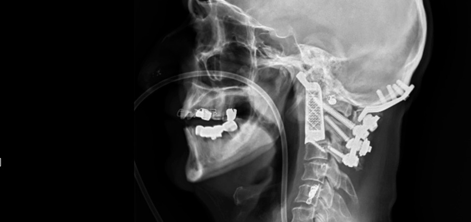 impresion-3d-vertebra