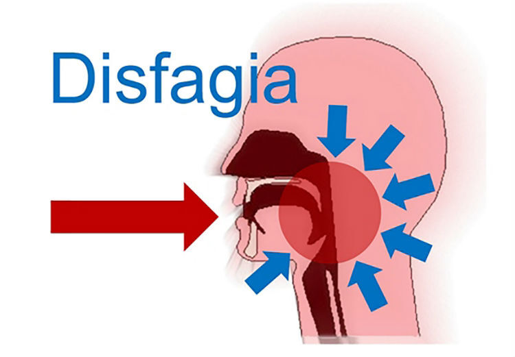 disfagia
