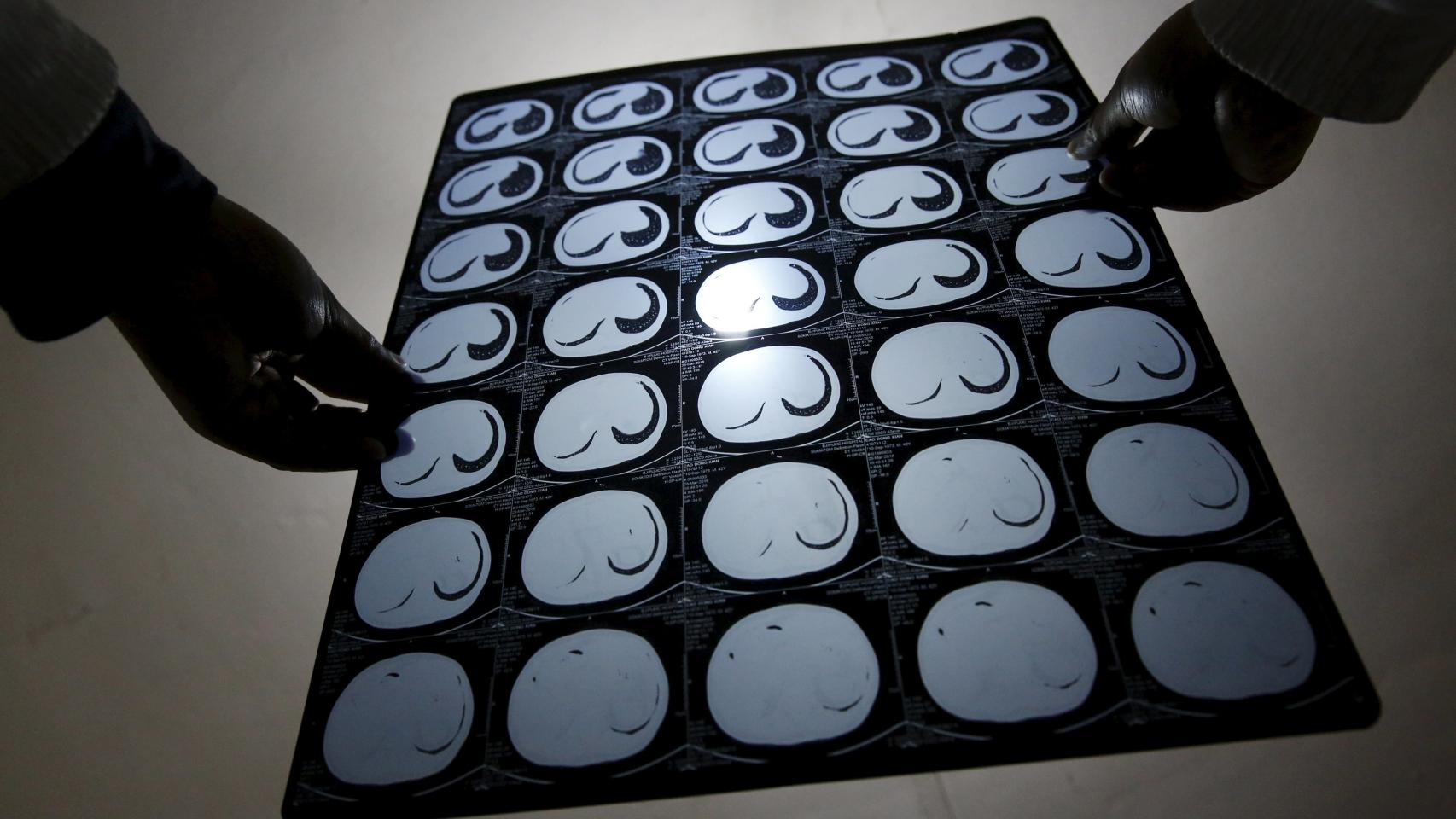 Un paciente de cáncer mira los resultados de un TAC.