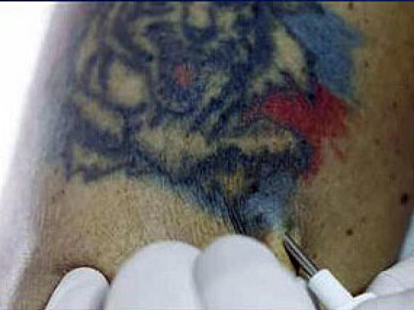 Ezequiel Rocino, secretaroio general de Tigre, en el momento de implantarse el chip.