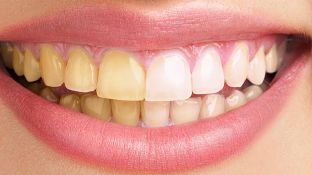 dientes amarillos