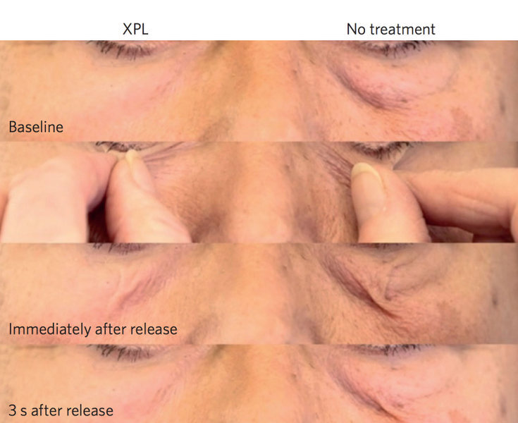 arrugas segunda piel 2