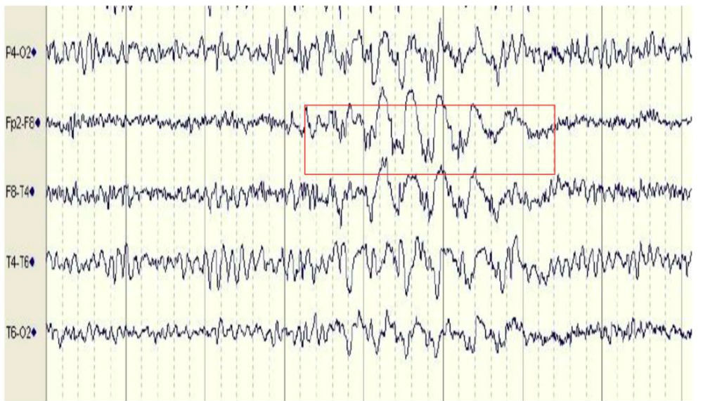 epilepsia_lobulo_frontotemporal