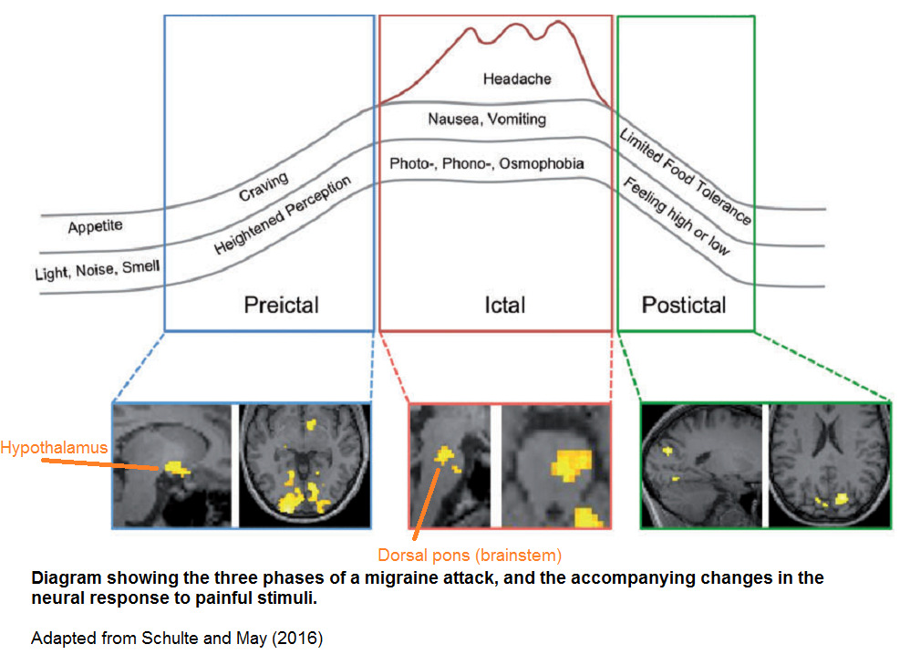 origen_cerebral_migraña