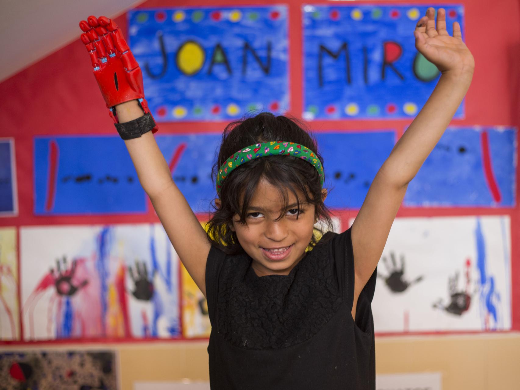 Mariam Sabar nació con una malformación en una de sus manos.