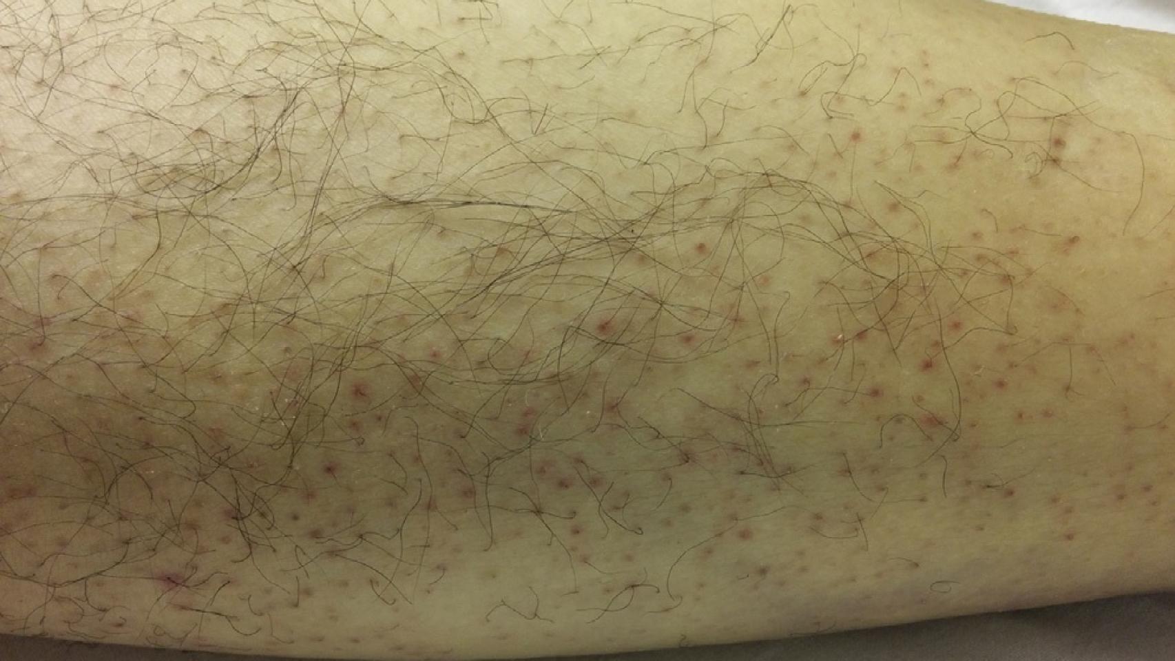Sarpullido en el brazo del varón diagnosticado con escorbuto.