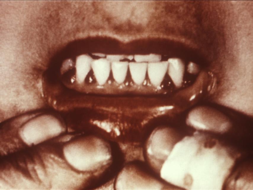 Encías con escorbuto.