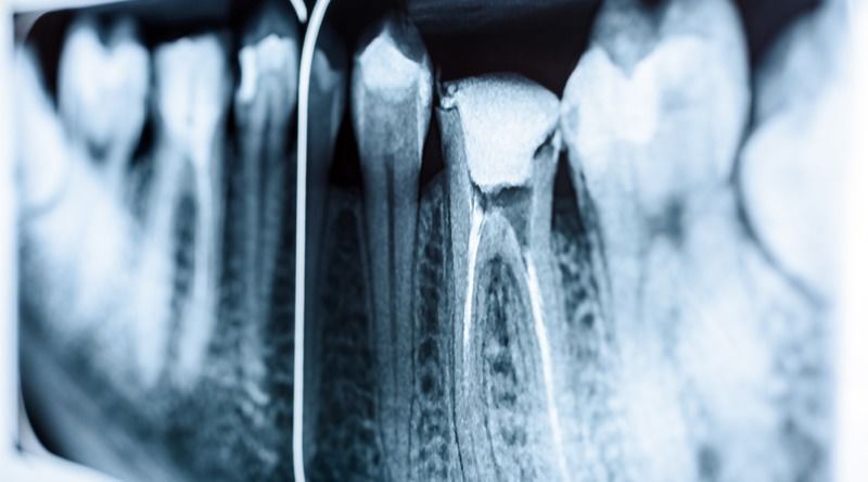 endodoncia