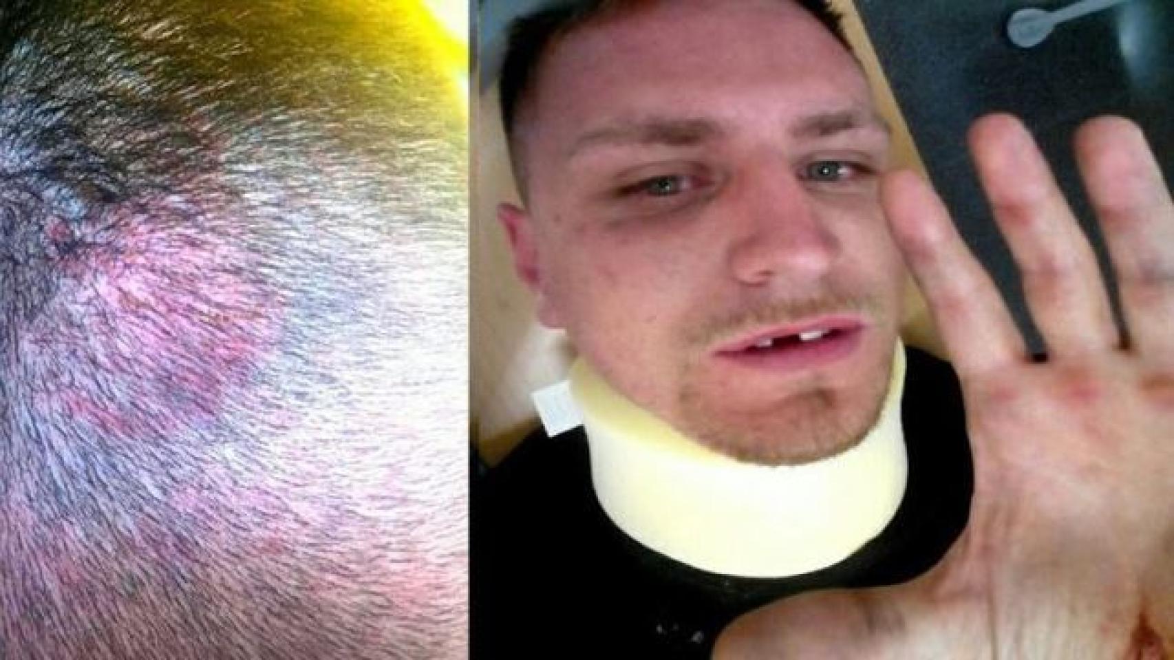 Óscar del Castillo, tras ser agredido.