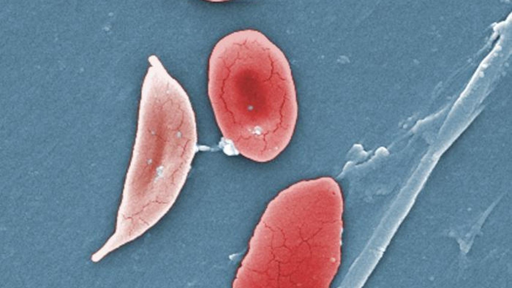 Anemia, mucho más que cansancio