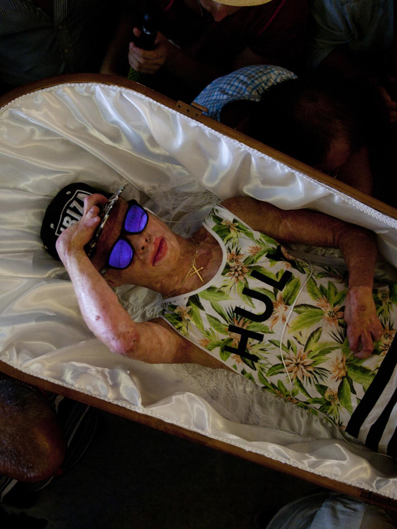 Aleixo, que tiene el cuerpo quemado, perdió a su padre en un accidente cuando ambos iban juntos en un camión.