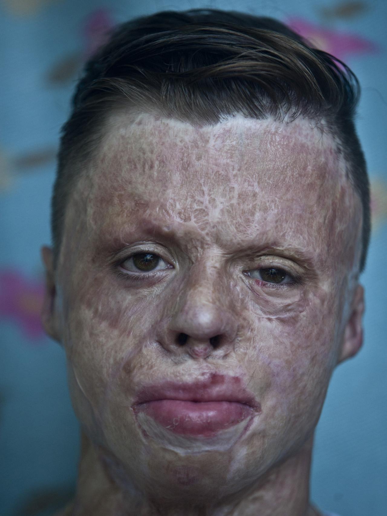 Primer plano de Aleixo, el niño de 15 años cuyo cuerpo está completamente quemado.