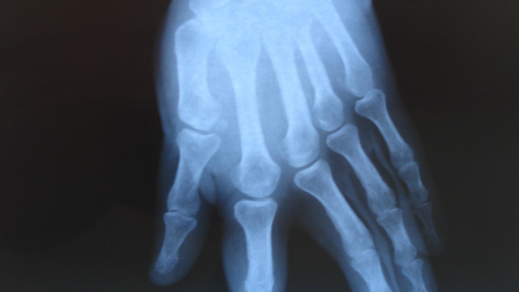 Una radiografía de la mano izquierda de Rafael