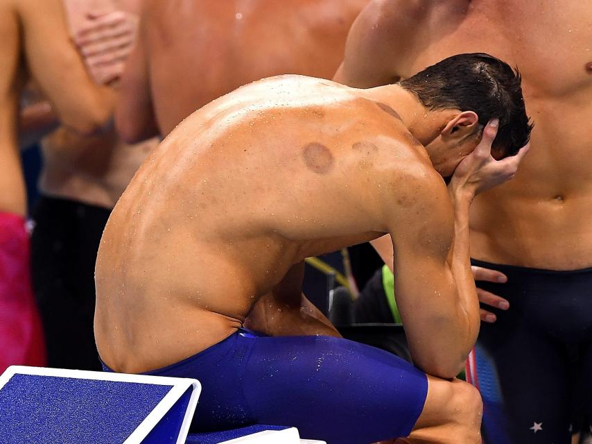 Las marcas de la piel de Phelps hicieron saltar todas las alarmas.