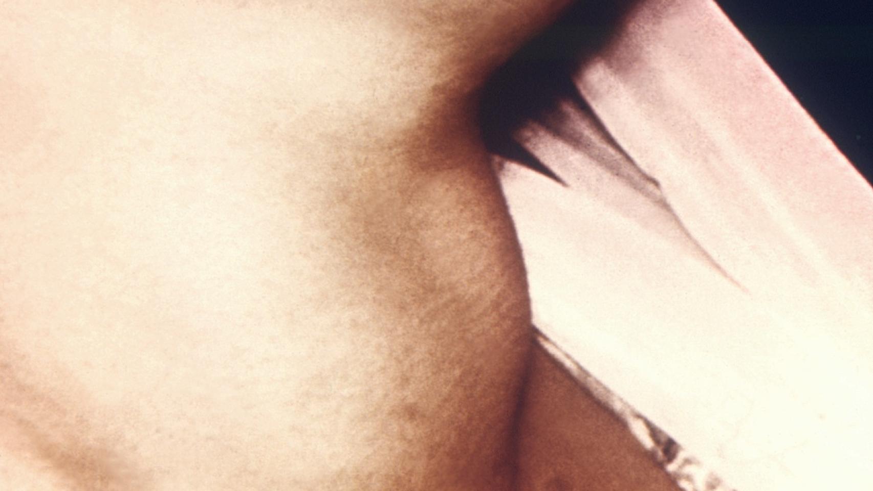 ¿Se sobrediagnostica el cáncer de tiroides?