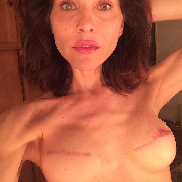 Lorena Meritano mostrando su mastectomía