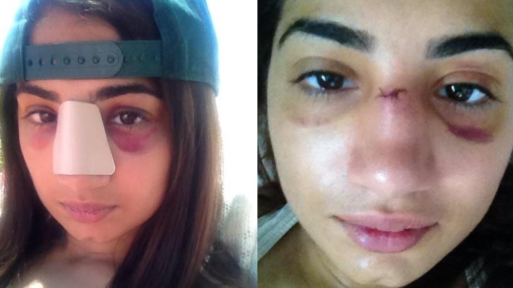 Ambreen Sadiq presume de nariz rota en sus redes sociales.