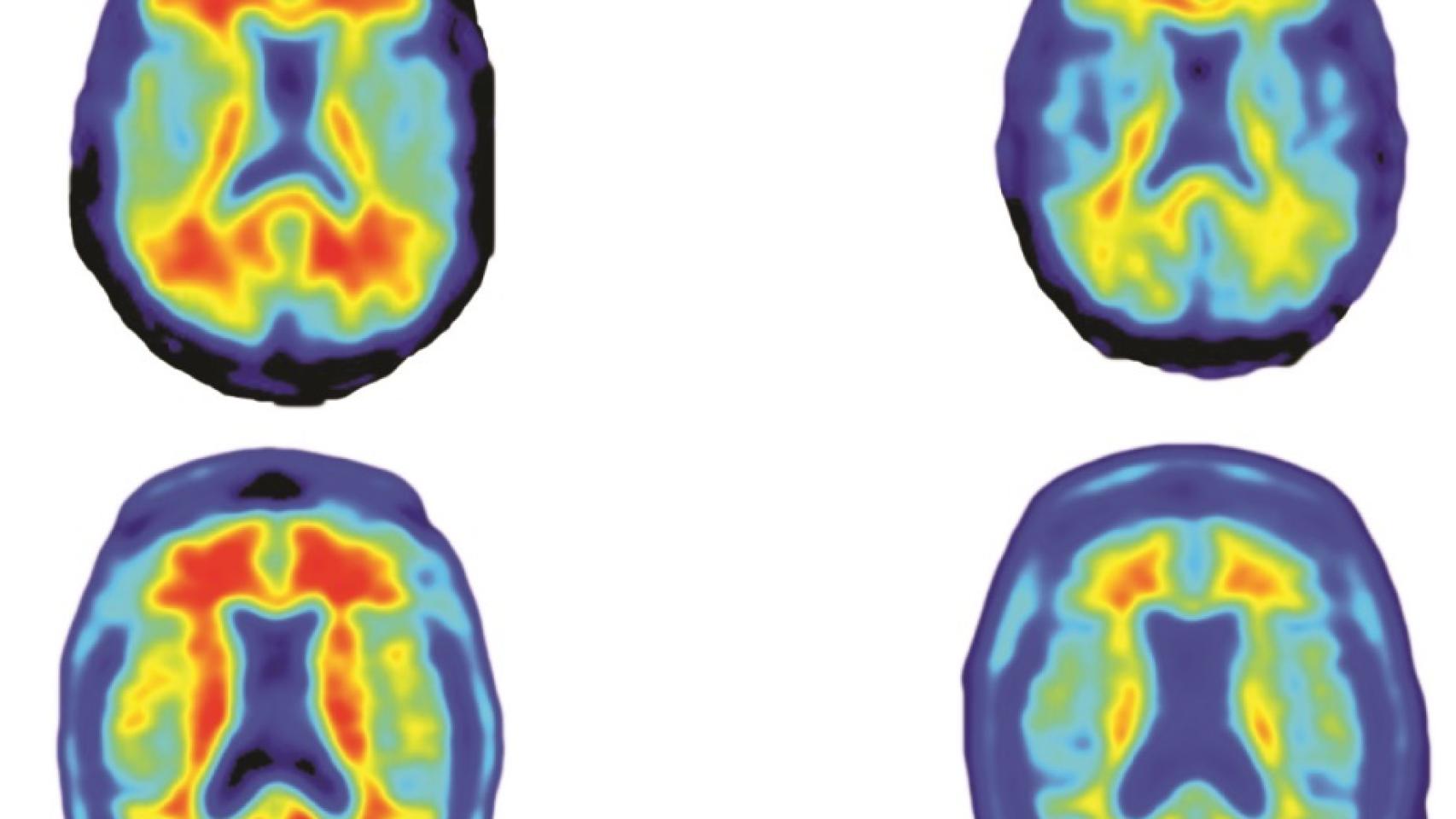 A la izquierda, cerebros sin tratar. A la derecha, tratados.