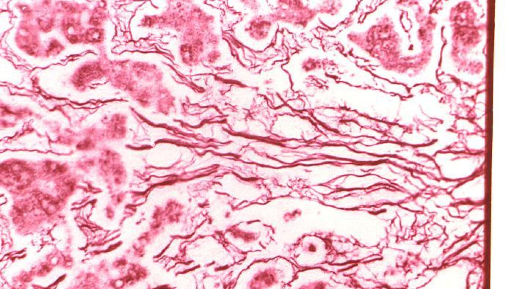 Tejido hepático de un enfermo de esta fiebre.