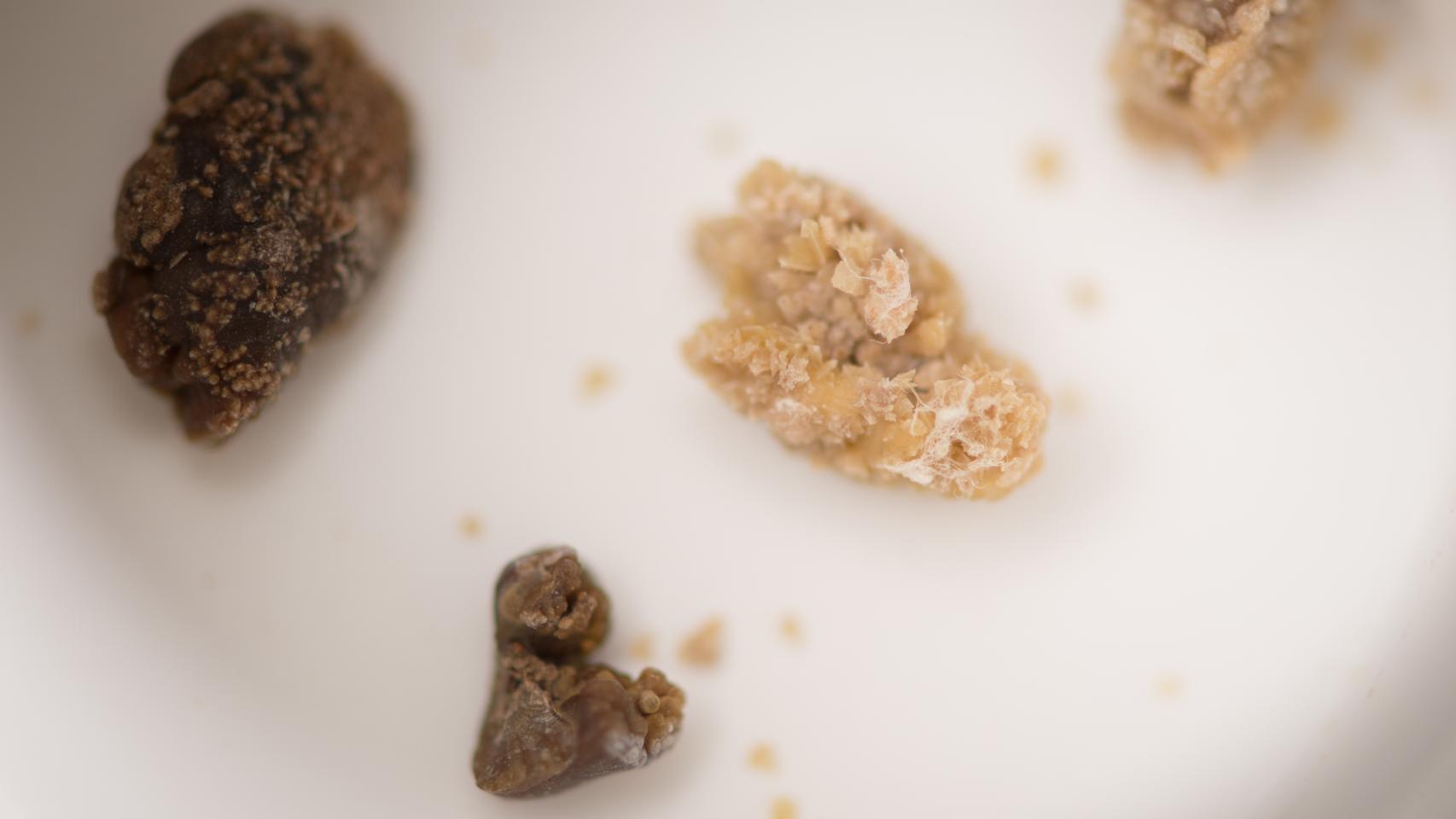 Cálculos renales, comúnmente llamados piedras del riñón.