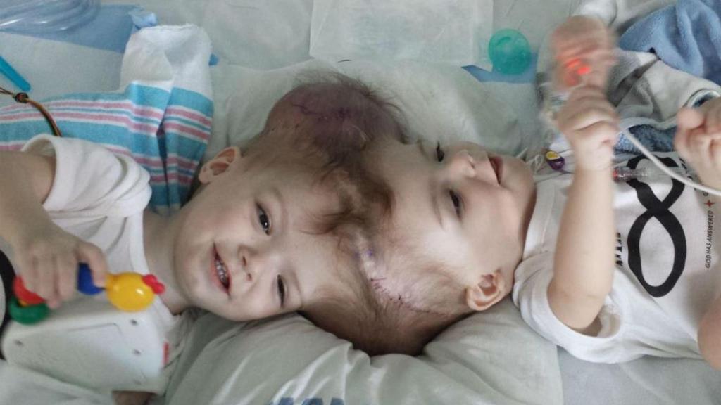 siameses unidos por el cerebro