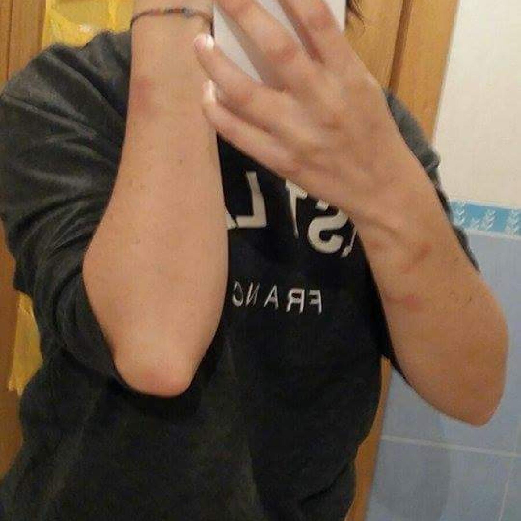 Vanesa muestra las lesiones que le produjo su novio en una agresión anterior