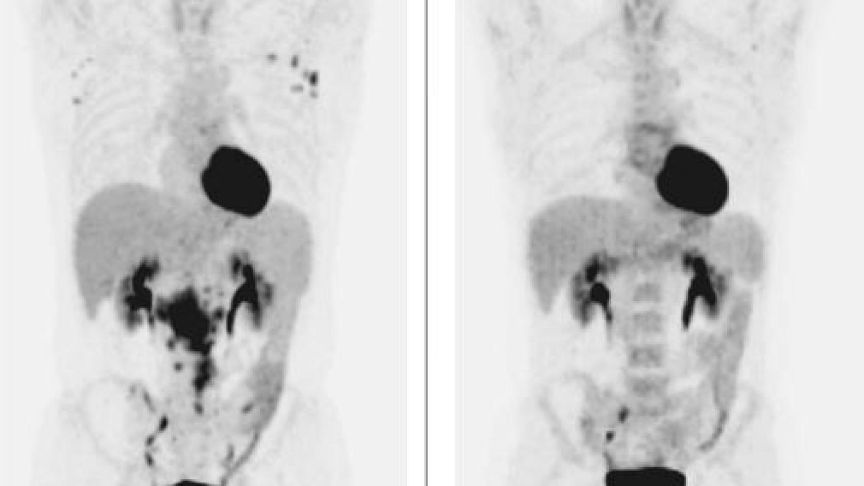 El tumor, antes y después del tratamiento para la hepatitis C.
