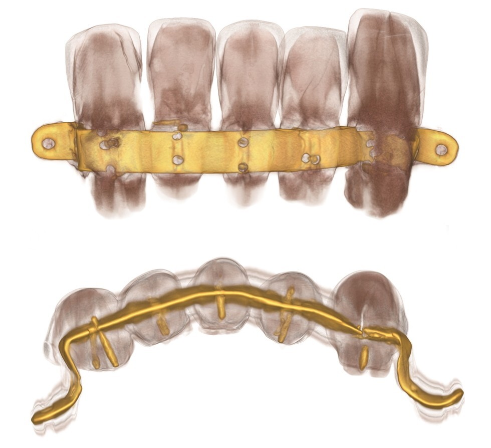 protesis_dental_antigua