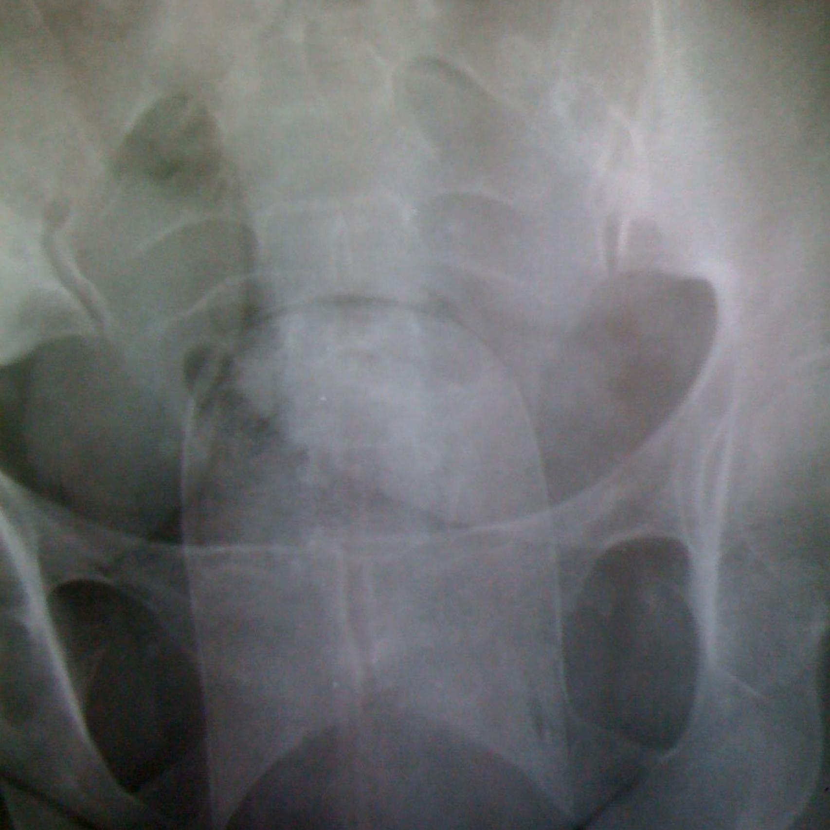 La radiografía revela la existencia de un 'pepino' de cocaína en el interior de la vagina