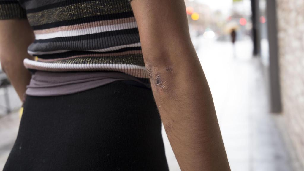 Las cicatrices del codo.