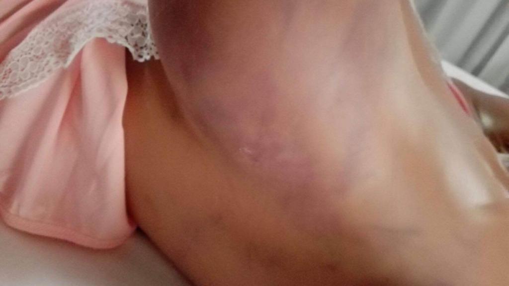 El vestido negro que pidió el cliente anterior destiñó en la piel de Lily