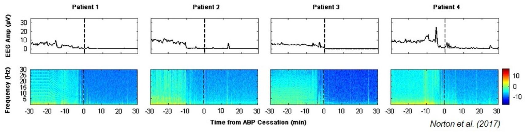 Estos son los encefalogramas de los cuatro pacientes: el color amarillo indica actividad cerebral.