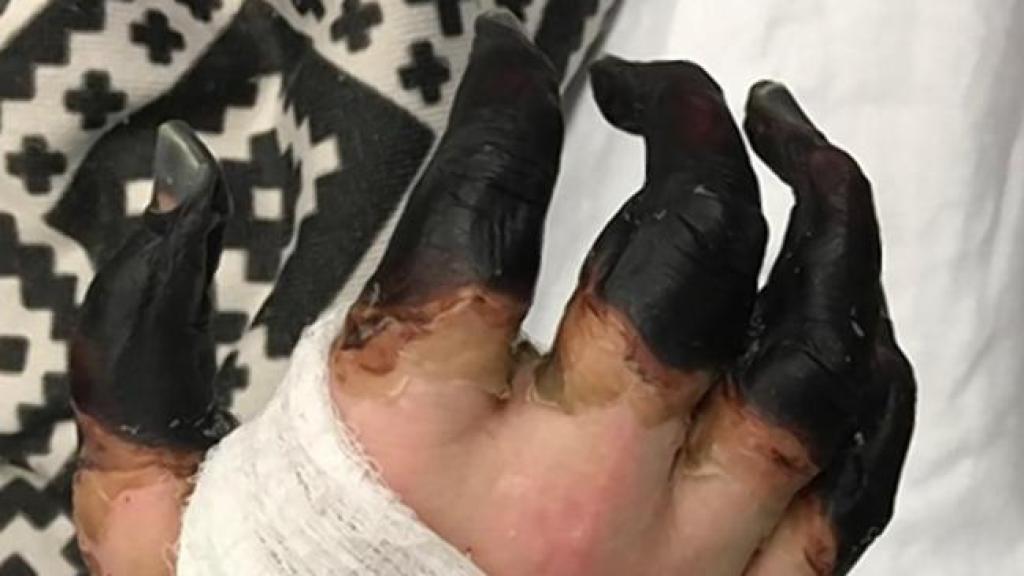 Así quedaron las manos del protagonista.