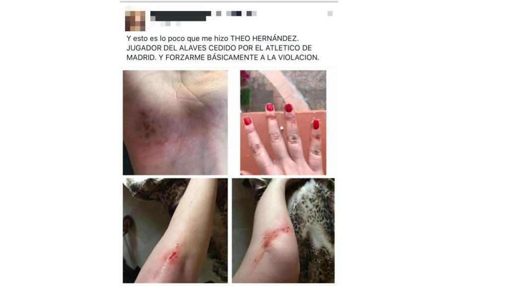 La presunta víctima de Theo Hernández difunde en la red imágenes de sus lesiones y luego las retira