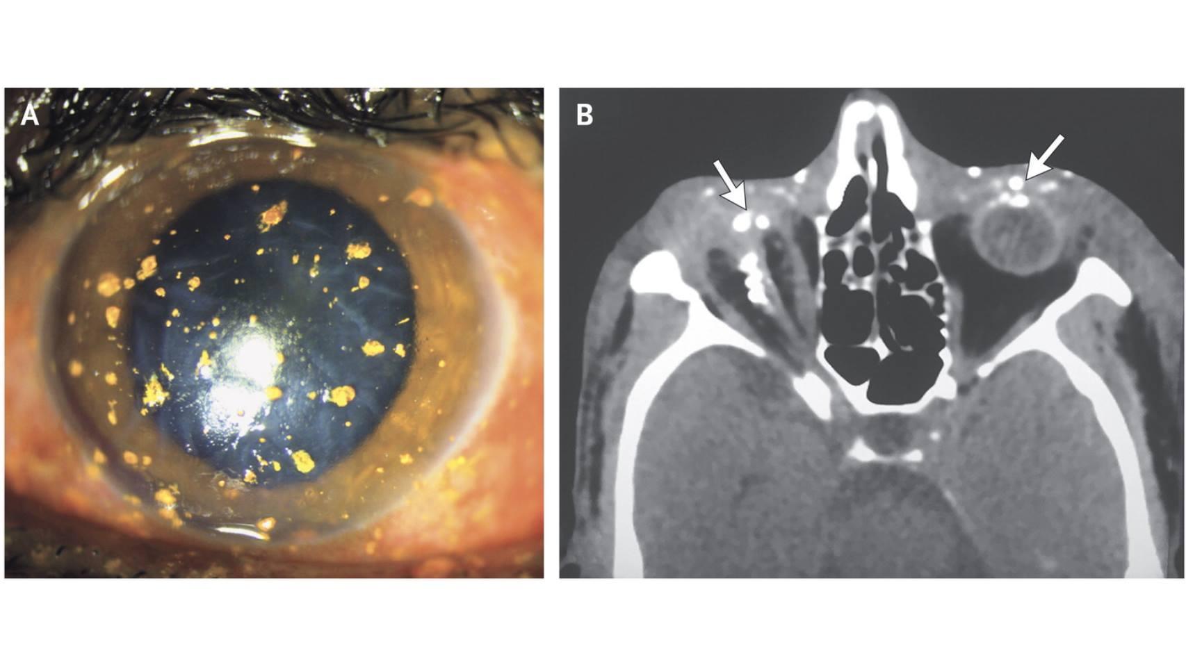 El caso del hombre cuyo ojo reventó cuando explotó el petardo que encendía