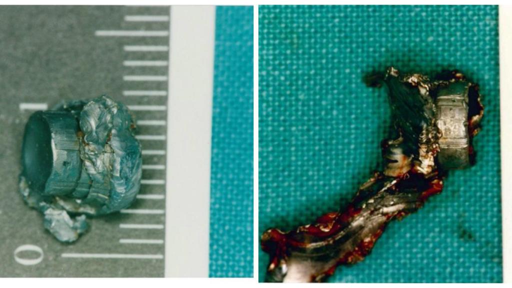 La primera bala que Txapote disparó contra Miguel Ángel Blanco  (izquierda) no lo habría matado. La bala que causó la muerte de Blanco es la de la derecha. Fue la segunda que Txapote le disparó.