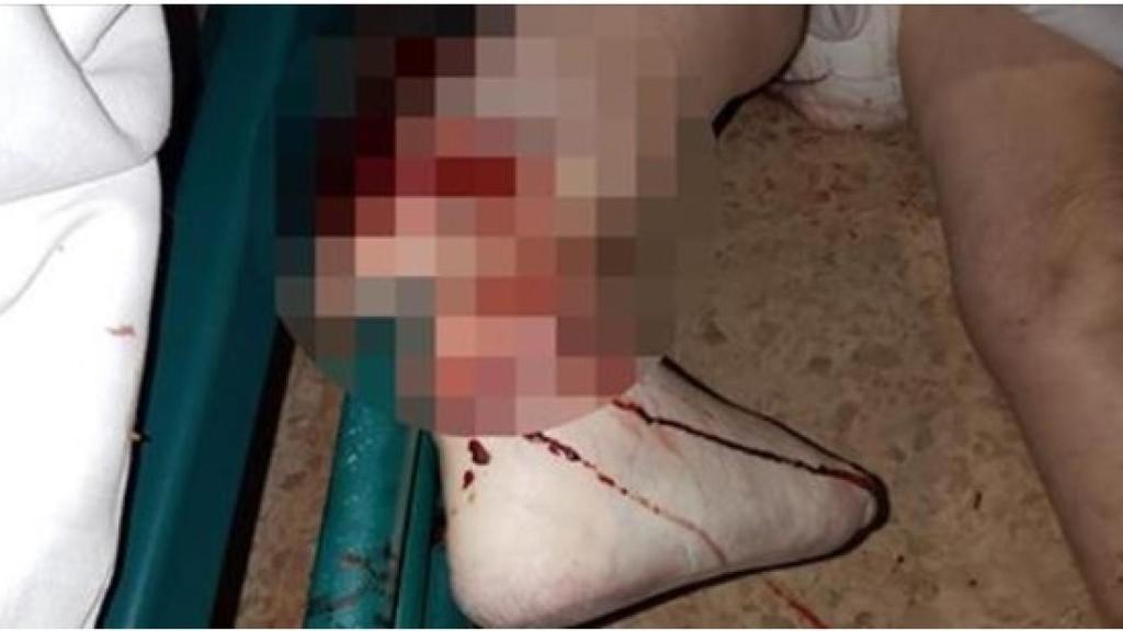 La pierna de Cecilia quedó completamente destrozada debido a la barra de sujeción.
