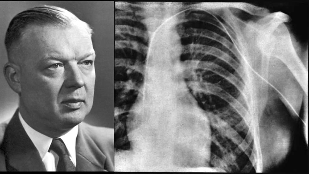 Werner Forssmann y su catéter.