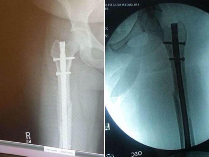 Radiografía de la pierna de Audra Tatum.