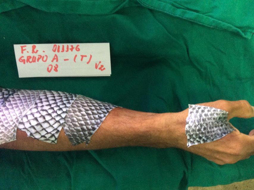Uno de los pacientes tratados con piel de pescado.