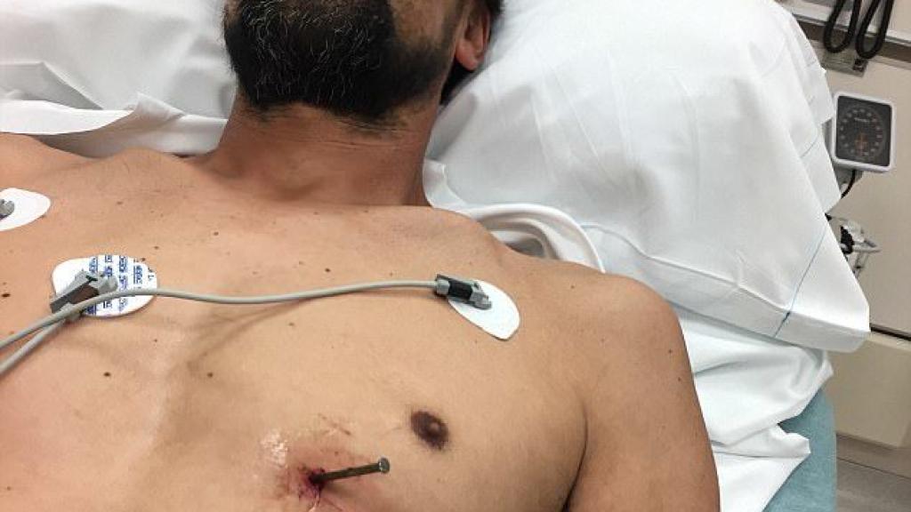 Doug Bergeson tumbado en la camilla con el clavo incrustado en su pecho.